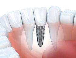 Dental Implants